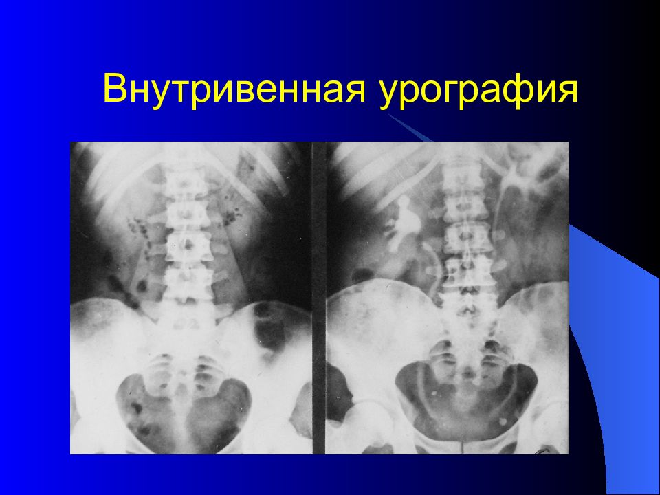 Внутривенная урография презентация