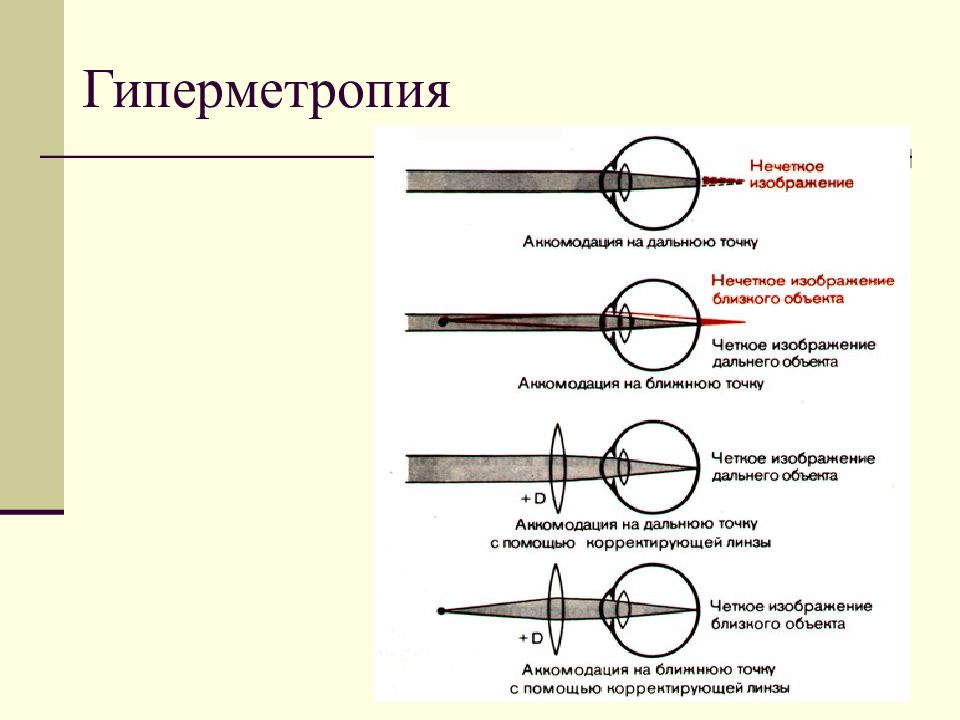 Что такое гиперметропия слабой степени