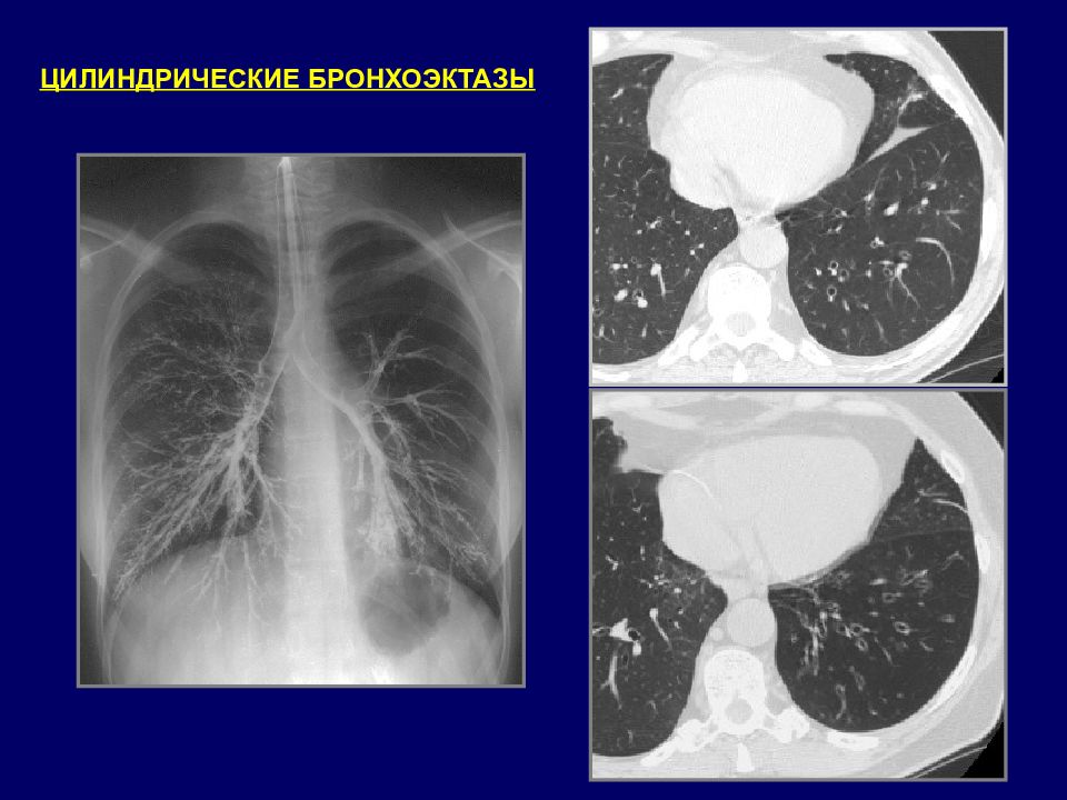 Лучевая диагностика это. Цилиндрические бронхоэктазы. Мешотчатые бронхоэктазы. Мешотчатые бронхоэктазы кт. Цилиндрические и мешотчатые бронхоэктазы.