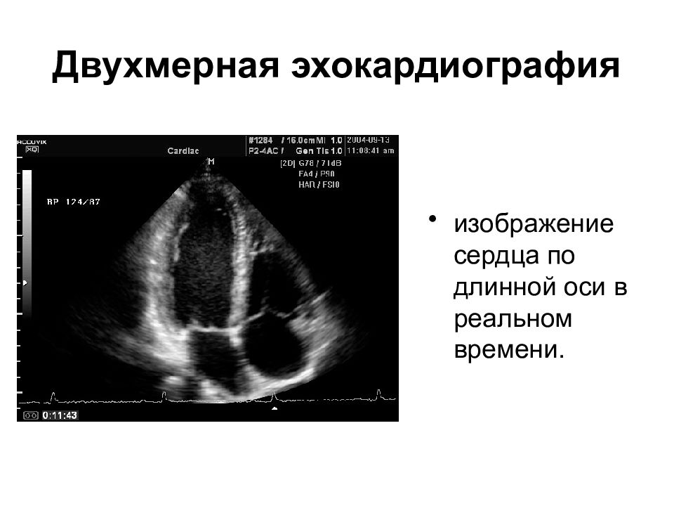 Эхокардиография сердца презентация