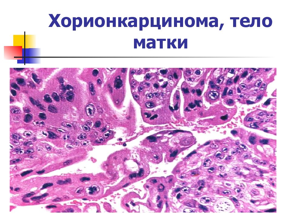 Трофобластическая болезнь презентация