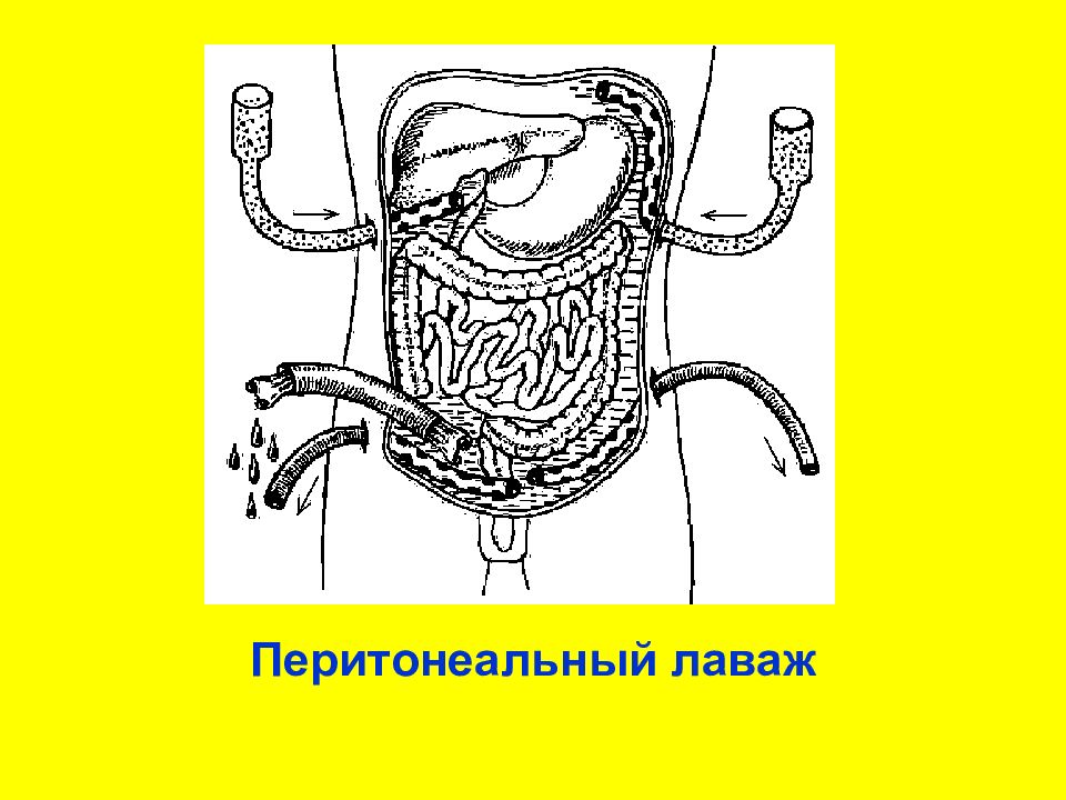 Схема дренирования брюшной полости при перитоните