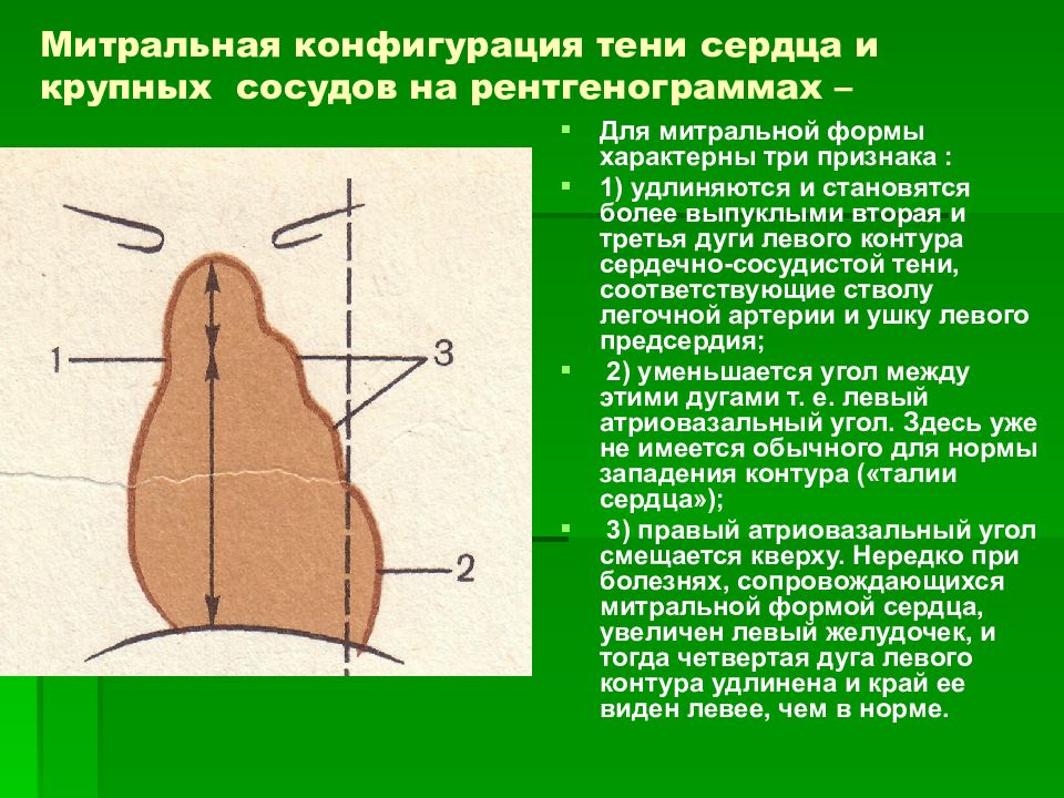 Митральное сердце. Тень сердца митральной конфигурации. Конфигурации сердечной тени. Митральная конфигурация сердца. Признаки митральной конфигурации сердца.