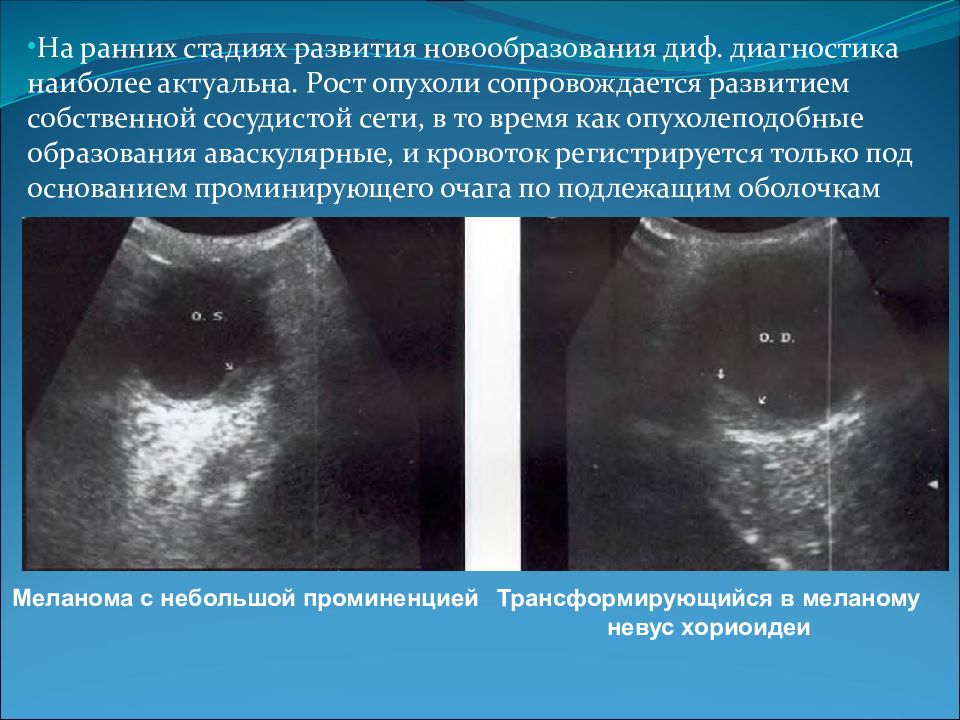 новообразование хориоидеи на узи. методы ультразвуковой диагностики. меланома хориоидеи узи. метастатические лимфоузлы на узи. меланома хориоидеи окт.