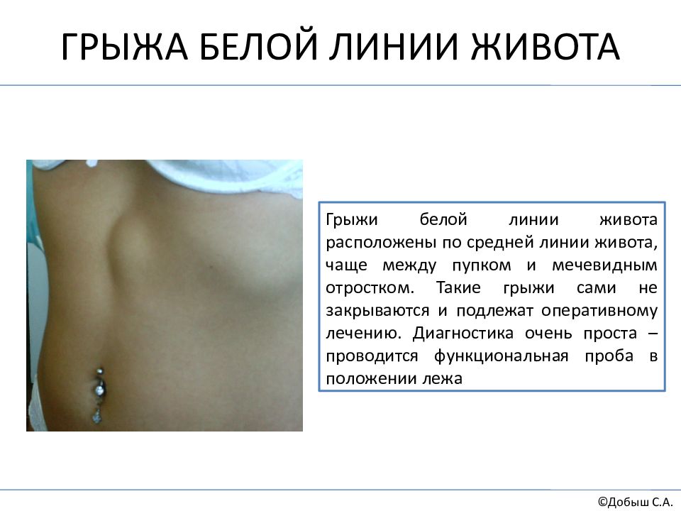 Мечевидный отросток картинка