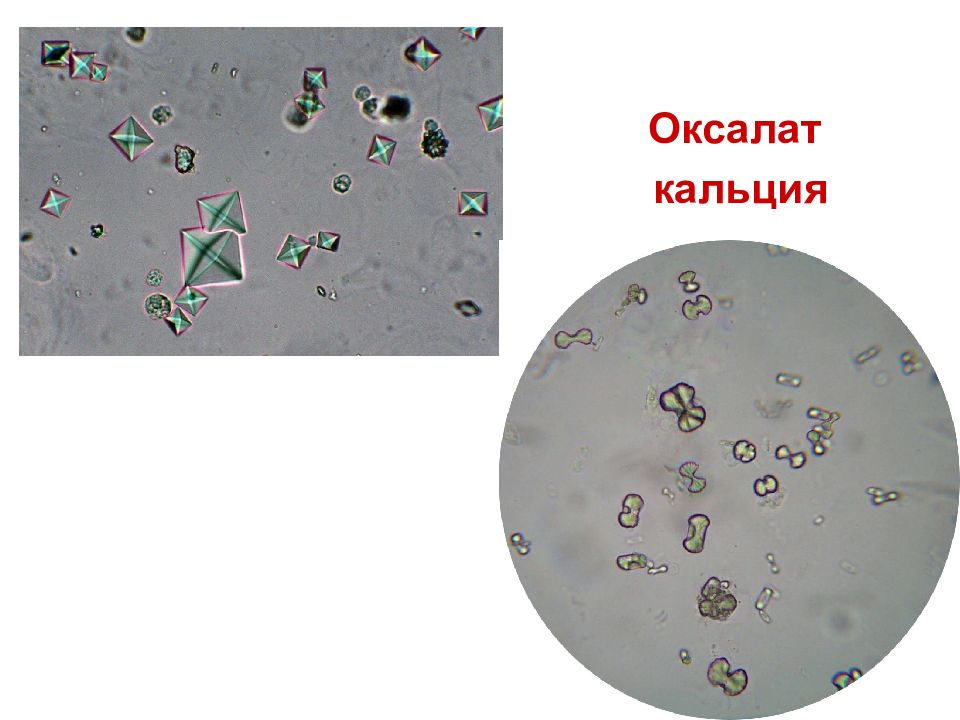 Осадки мочи фото