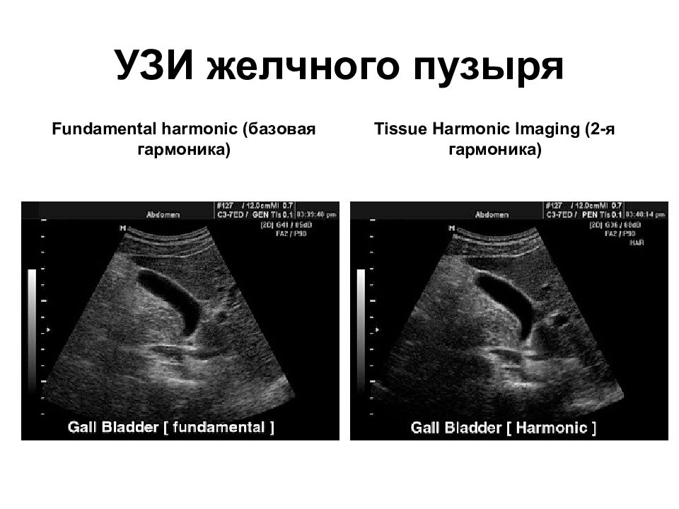 Есть ли узи. Строение желчного пузыря на УЗИ. УЗИ заполненный желчный пузырь. УЗИ печени и желчного пузыря. УЗИ печени и желчного пузыря норма.