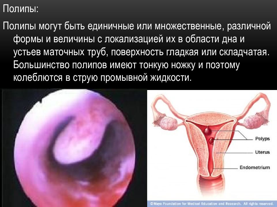 Гистероскопия месячный приходить