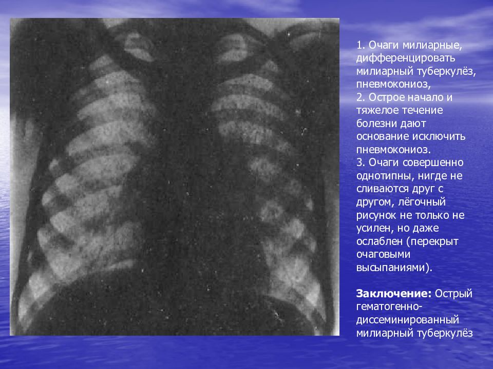 Очаговое поражение легких. Милиарный диссеминированный туберкулез рентген. Острый милиарный туберкулез. Размер очагов в легких при остром милиарном туберкулезе. Острый общий милиарный туберкулез.