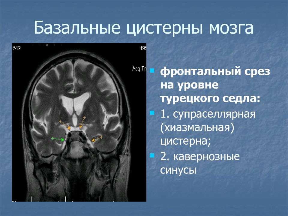 Базальные цистерны головного