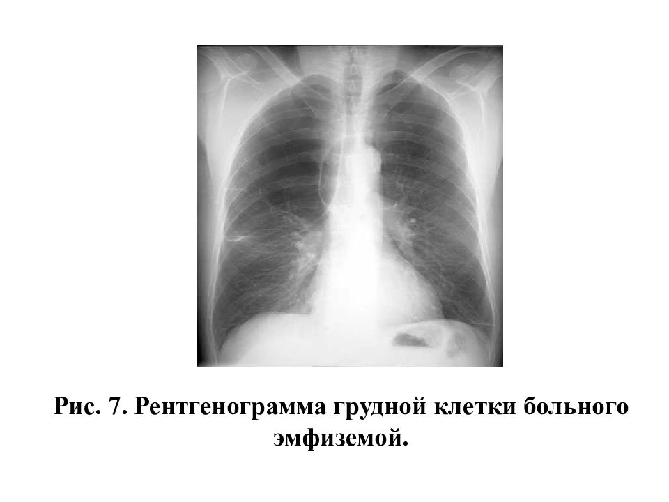 Массаж при эмфиземе. Рентгенография грудной клетки при эмфиземе. Форма грудной клетки при эмфиземе легких. Подкожная эмфизема рентген описание. Эмфизема лёгких фото человека.