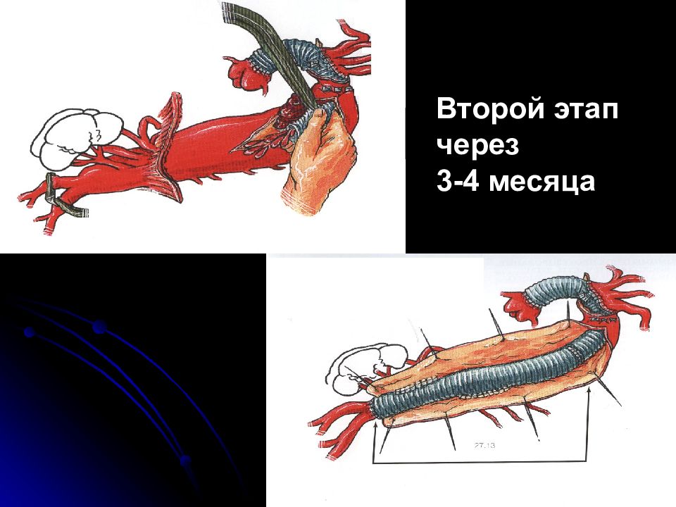 Язва аорты