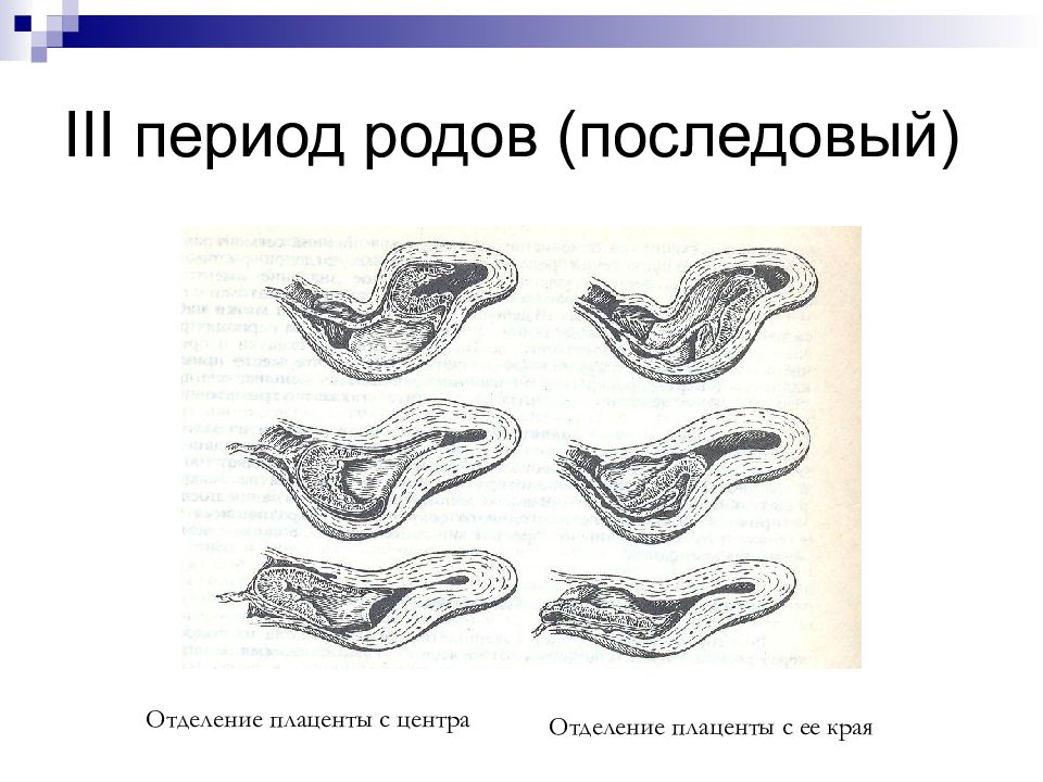 Роды акушерство. Последовый период 3 период родов. Третий период родов отделение последа. Отделение плаценты в последовом периоде. Фазы отделения плаценты.