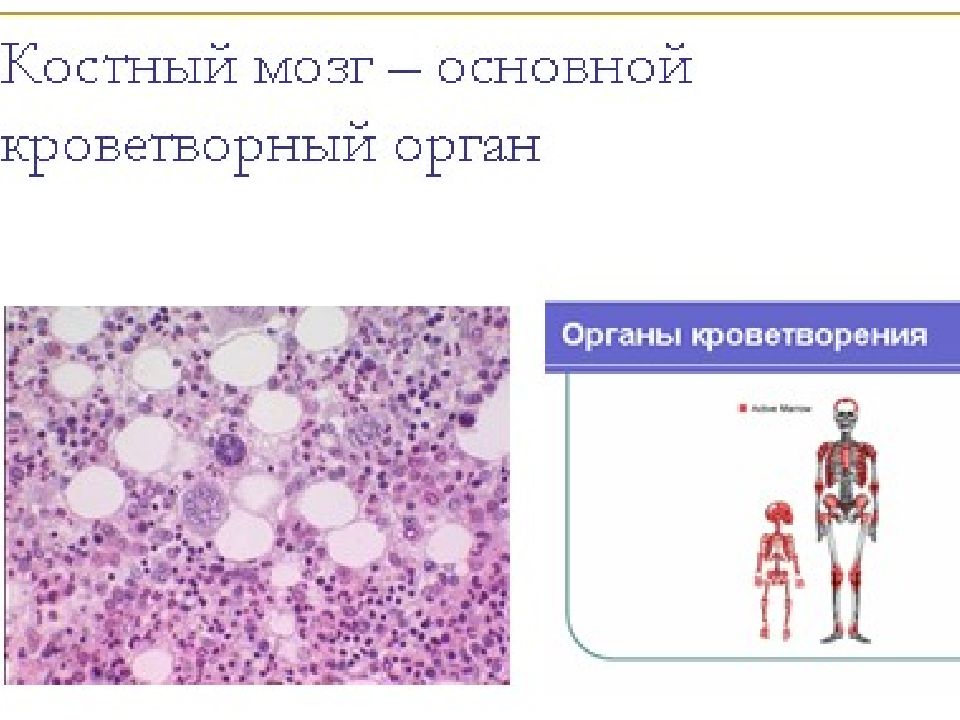 Лейкозы презентация патанатомия