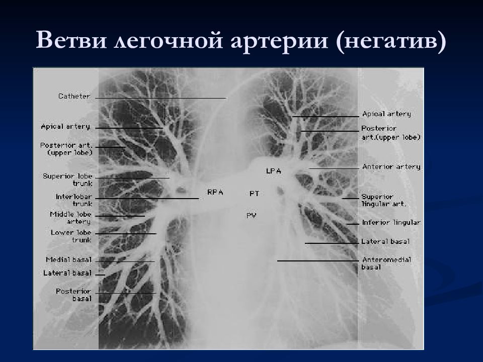 Легочная артерия где находится у человека схема