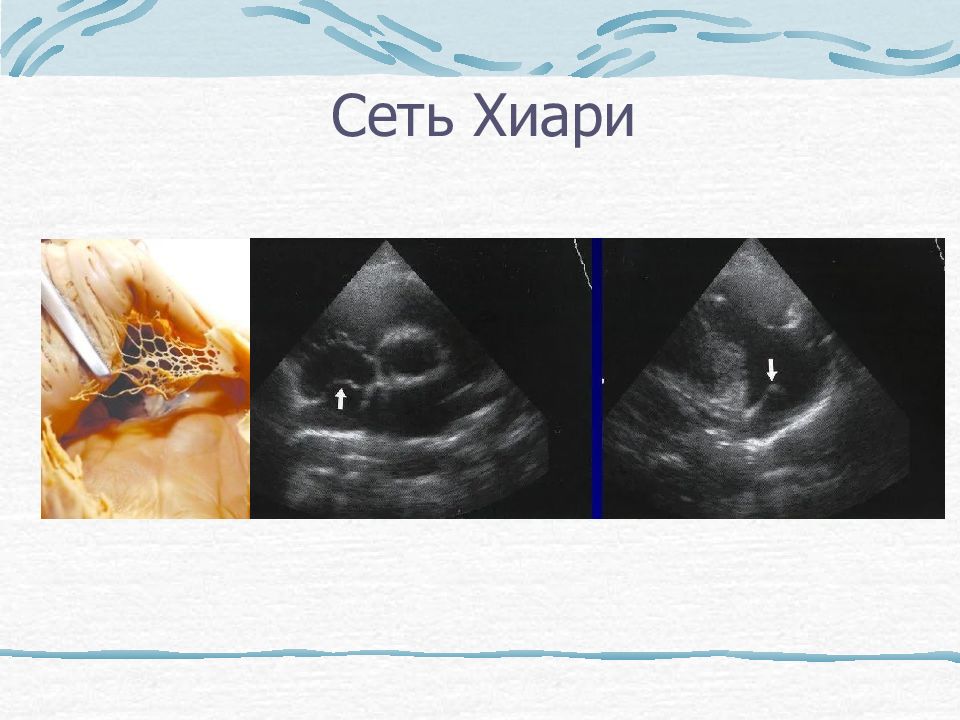 сеть киари в правом предсердии. сеть хиари на эхокг. сеть хиари правого предсердия. сеть хиари в правом предсердии. евстахиев клапан на эхокг.