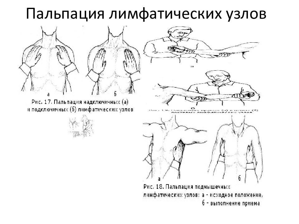 Пальпация лимфатических узлов. Порядок пальпации лимфатических узлов. Схема пальпации надключичных лимфоузлов. Пальпация лимфатических узлов алгоритм. Пальпация периферических лимфатических узлов.