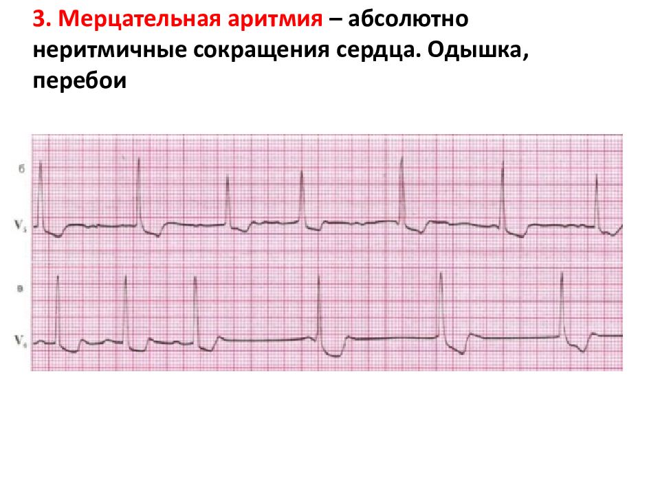 Аритмии и блокады сердца презентация