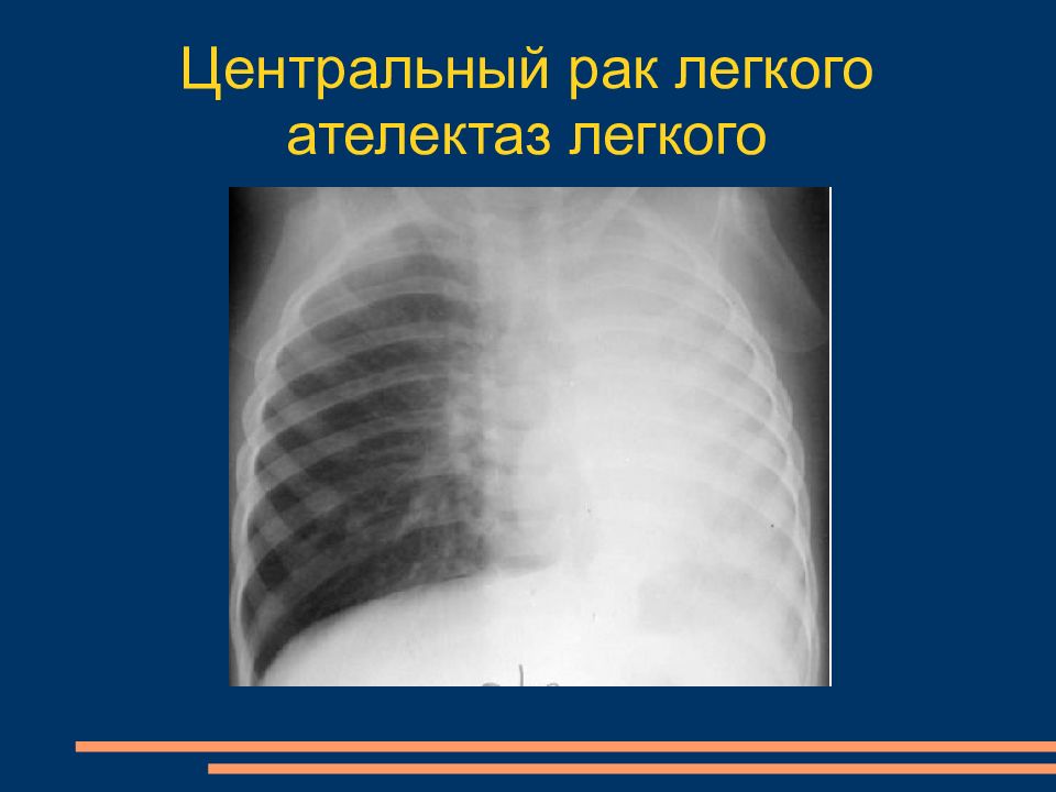 Центральный рак. Очаговый ателектаз. Рентгенодиагностика ателектазов легких. Рентгенология ателектаз легких легких.