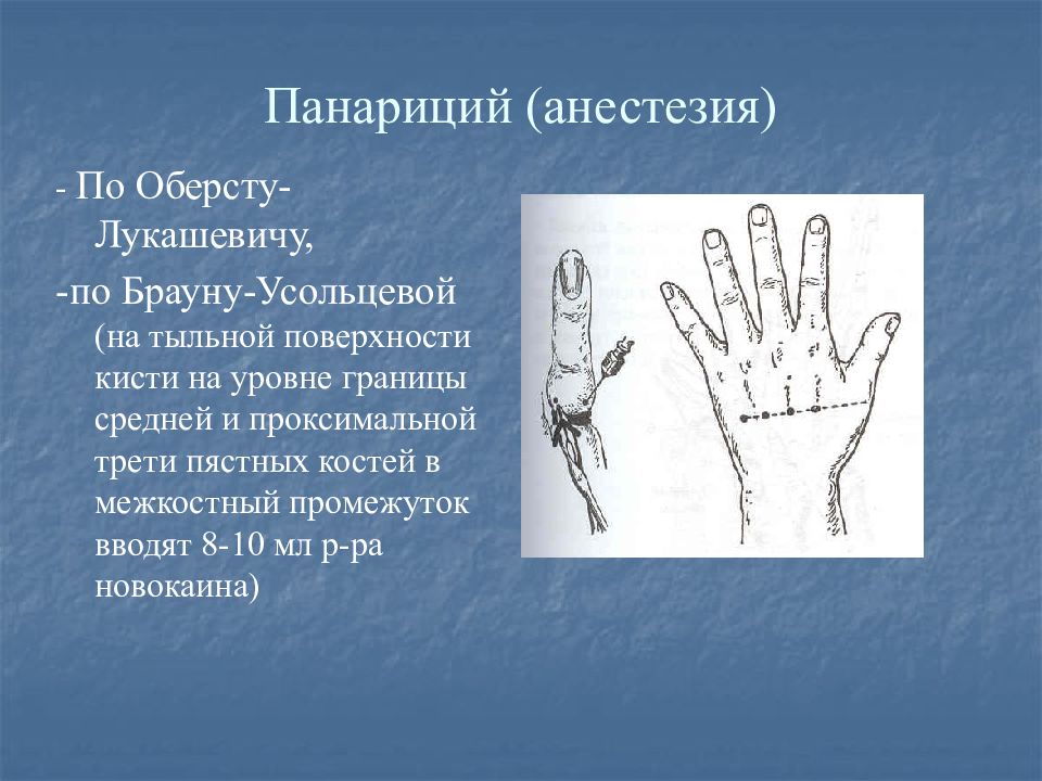 Блокада кисти. Проводниковая анестезия по Брауну-Усольцевой. Анестезия по Брауну Усольцевой. Панариций анестезия по Лукашевичу. Проводниковая анестезия пальцев кисти.