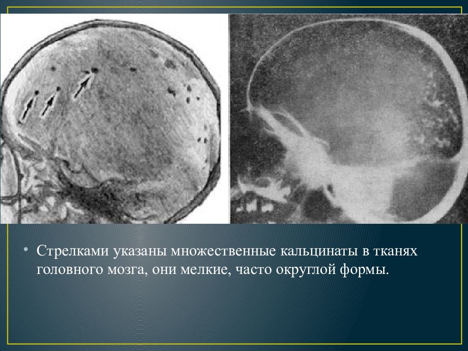 Презентация токсоплазмоз у детей