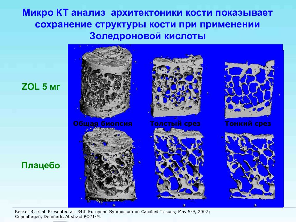 Переломы проксимального отдела бедренной кости презентация