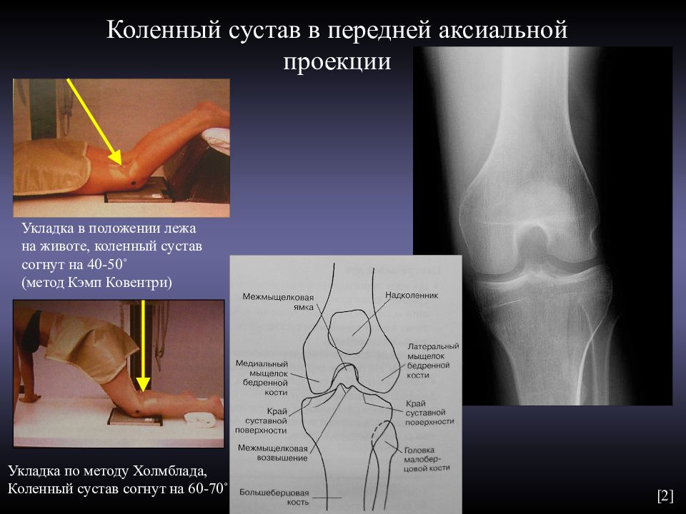 Аксиальная проекция. Аксиллярная проекция коленного сустава. Аксиальная проекция надколенника. Аксиальная проекция коленного сустава. Рентген коленного сустава в аксиальной проекции.