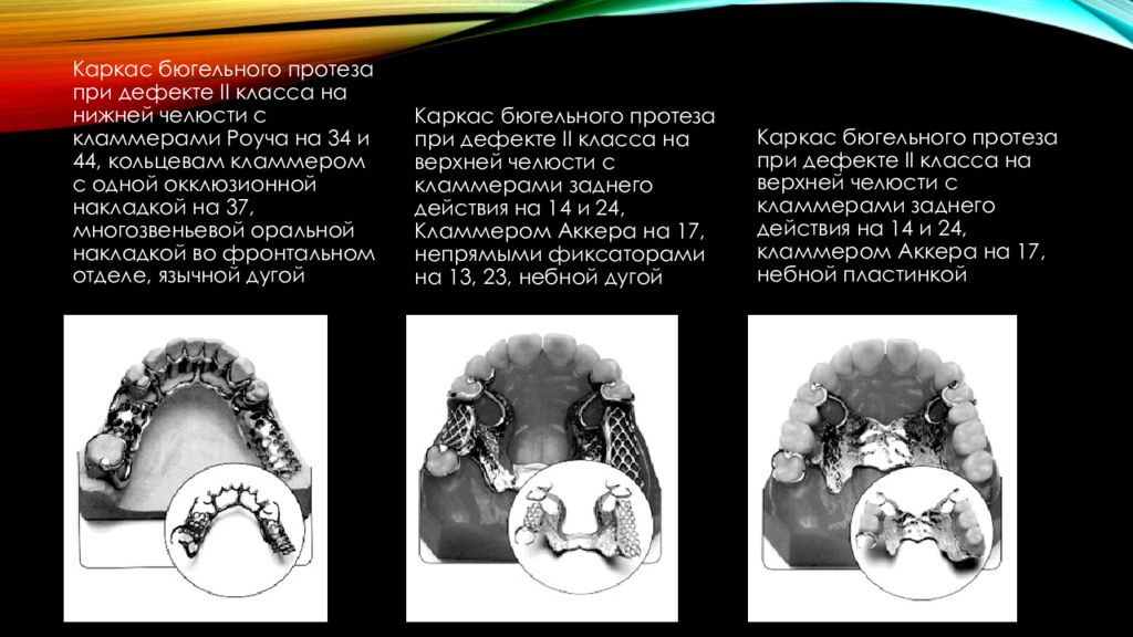 Презентация на тему бюгельный протез