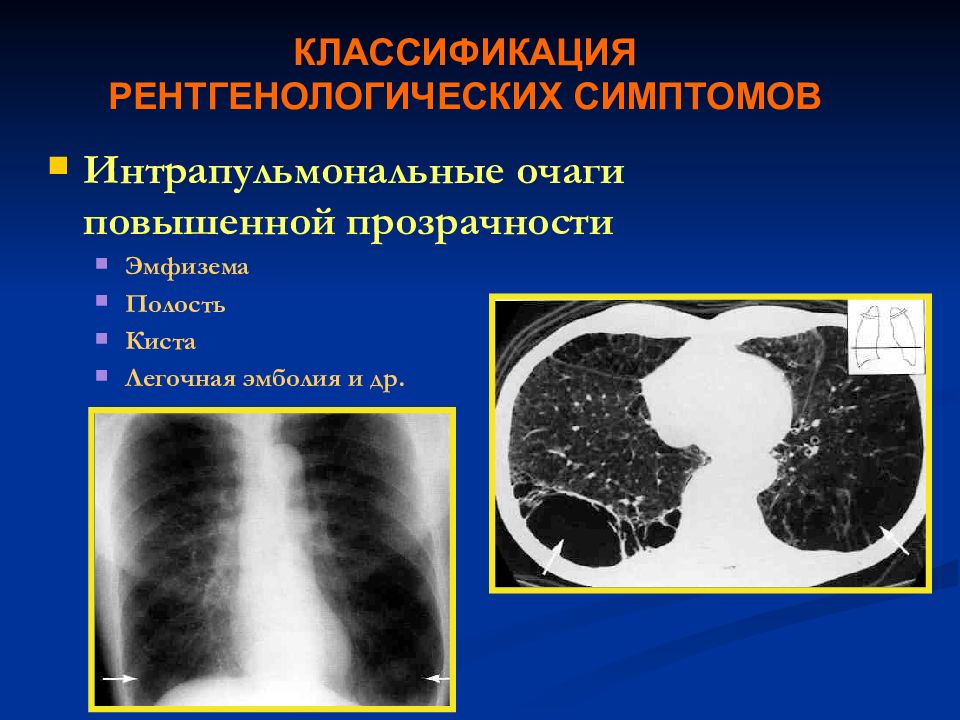 Рентгенологические признаки. Эмфизема рентгенологические признаки. Рентгеносемиотика заболеваний органов грудной клетки. Эмфизема рентгеносемиотика. Рентгеносемиотика заболеваний легких.