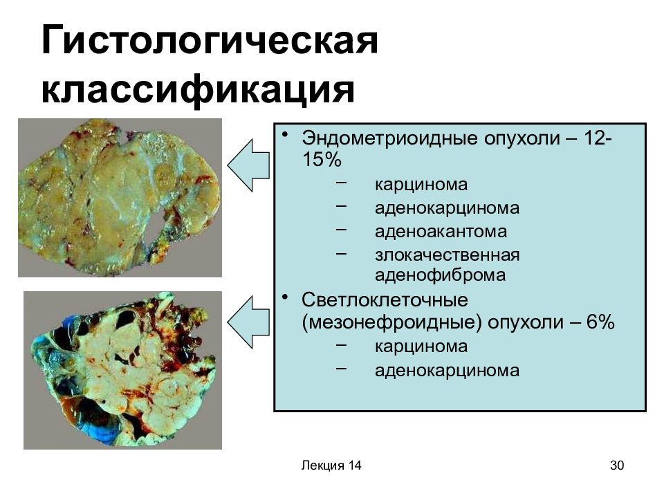 Эндометриоидная аденокарцинома яичника