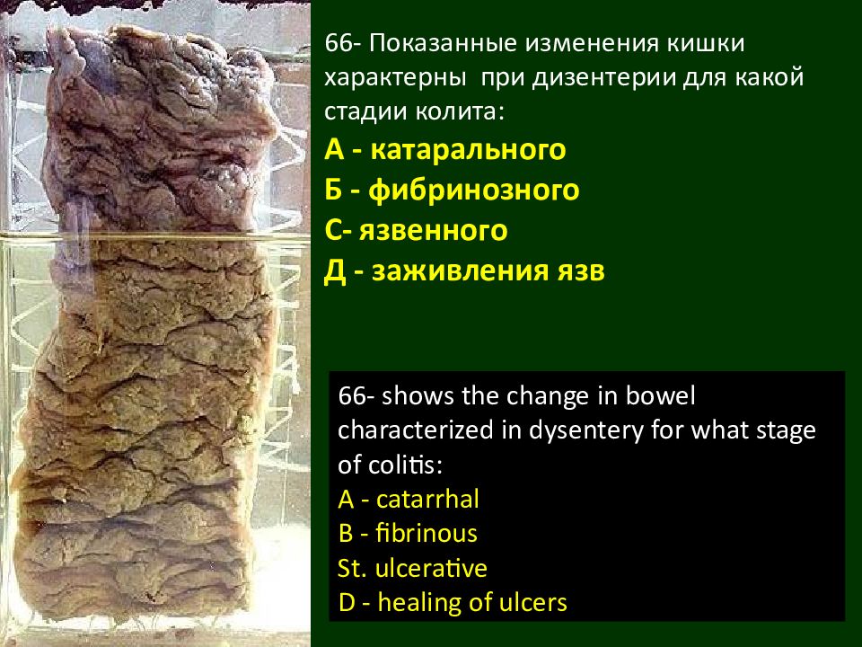 Дизентерия презентация патологическая анатомия