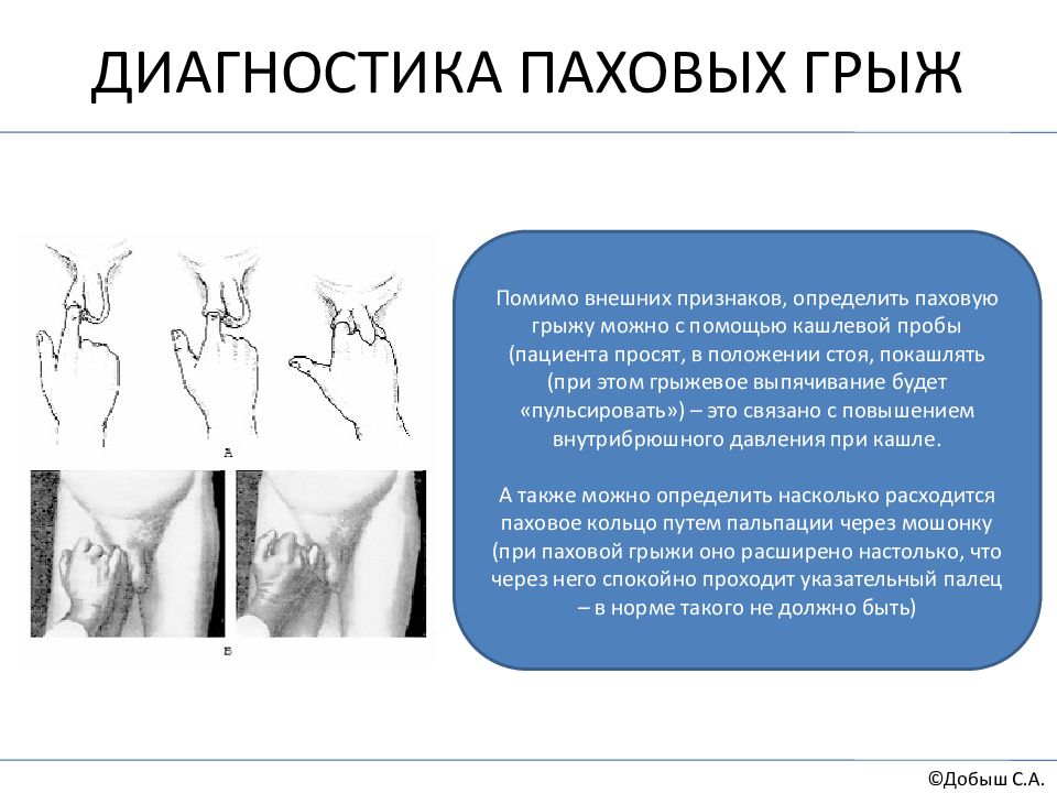 Паховая грыжа карта сестринского наблюдения