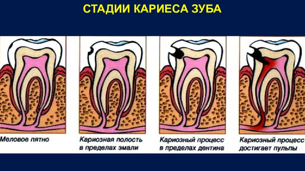 Стадии кариеса. Первоначальная стадия кариеса.