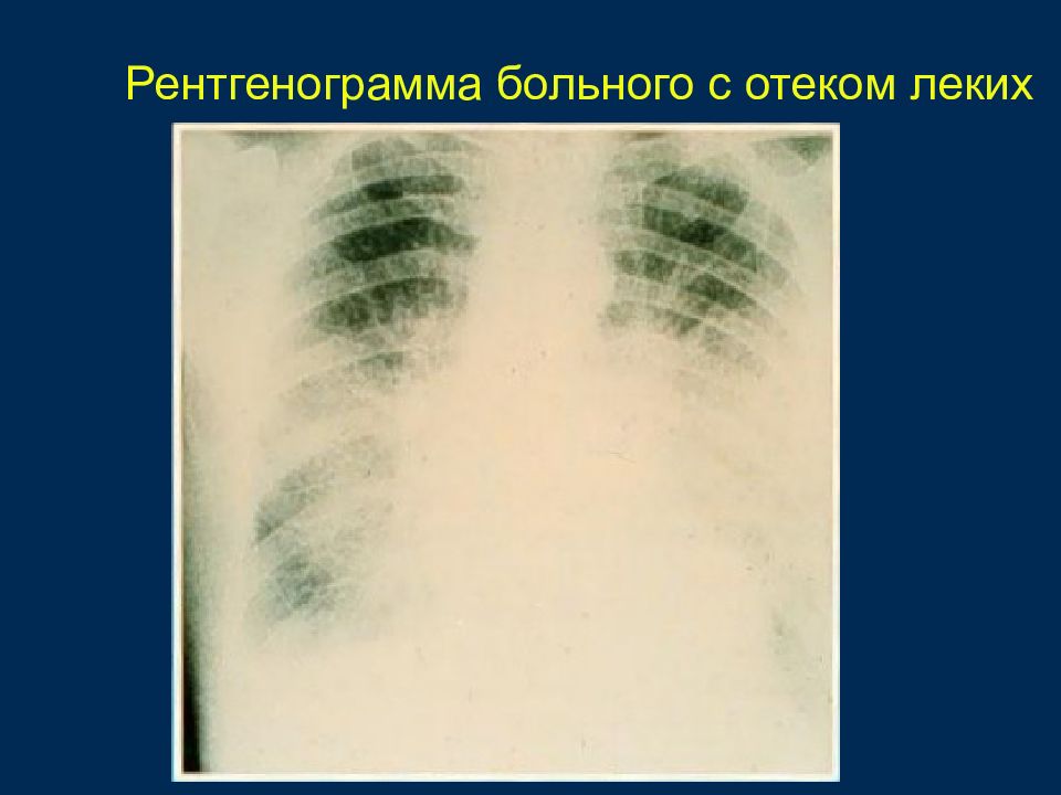 Рентгенологическая картина отека легких