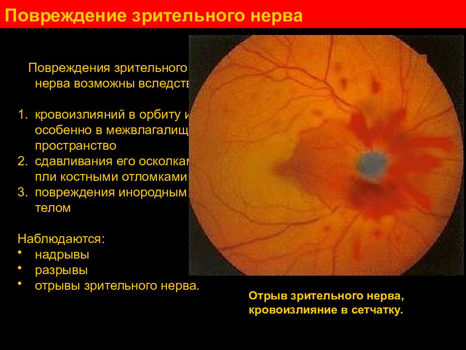 Лечение глазного нерва. Симптомы поврежденного зрительного нерв. Разрыв зрительного нерва. Симптоматика разрыва зрительного нерва. Повреждение глазного нерва.