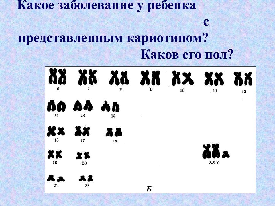 Какими особенностями кариотипа определяется пол. Кариотип галактоземии. Кариотип при галактоземии. Галактоземия кариотип больного. Кариотип больного с галактоземией.