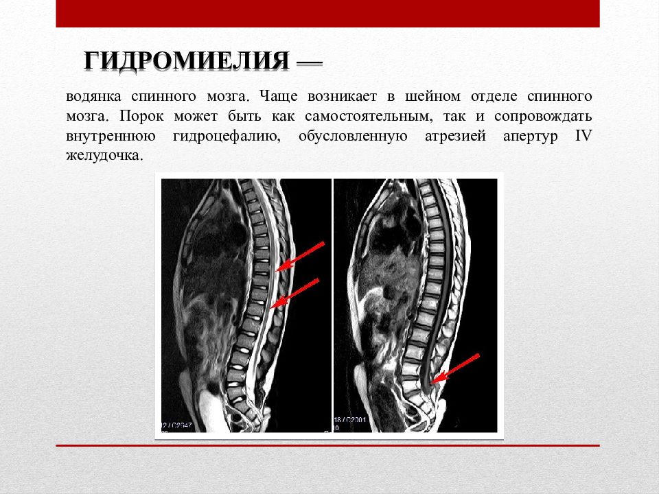 Гидромиелия шейного отдела