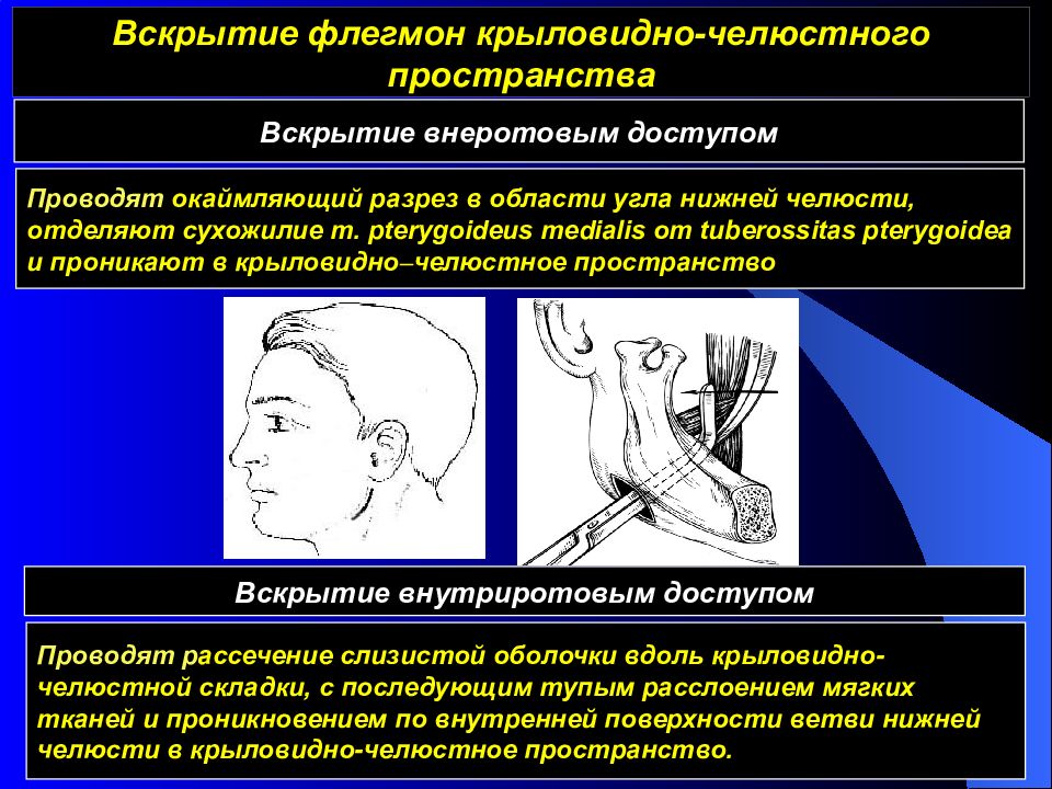 Вскрытие подапоневротической флегмоны