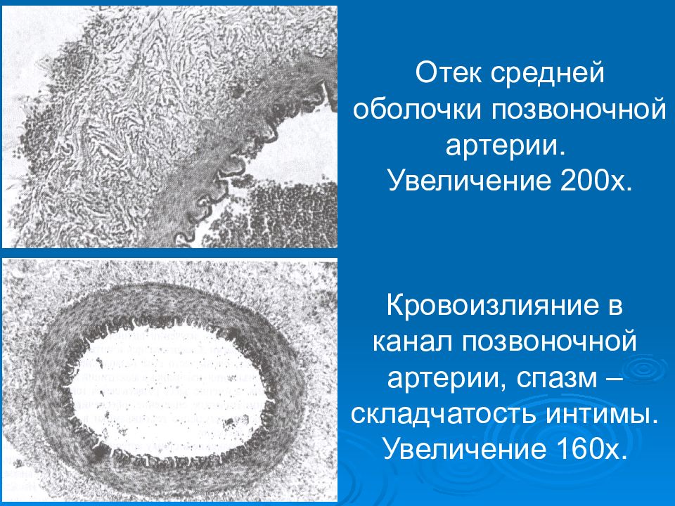 Увеличение 200. Повреждение средней оболочечной артерии. Чем опасен разрыв средней оболочечной артерии.