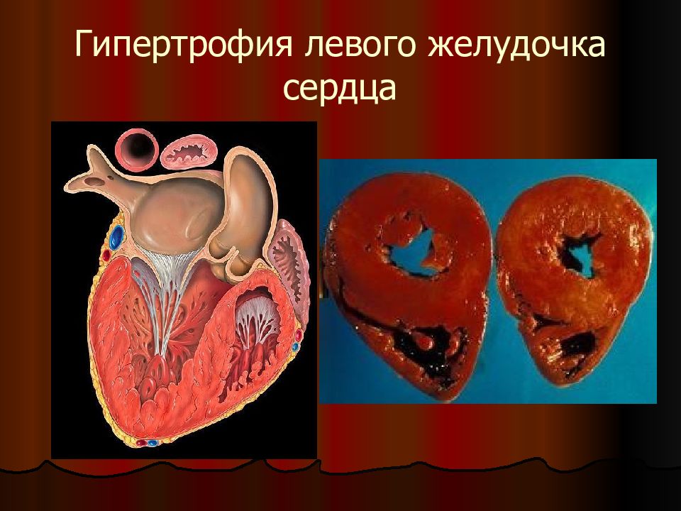 Глж сердца. Гипертрофия миокарда желудочков. Гипертрофия миокарда левого желудочка.