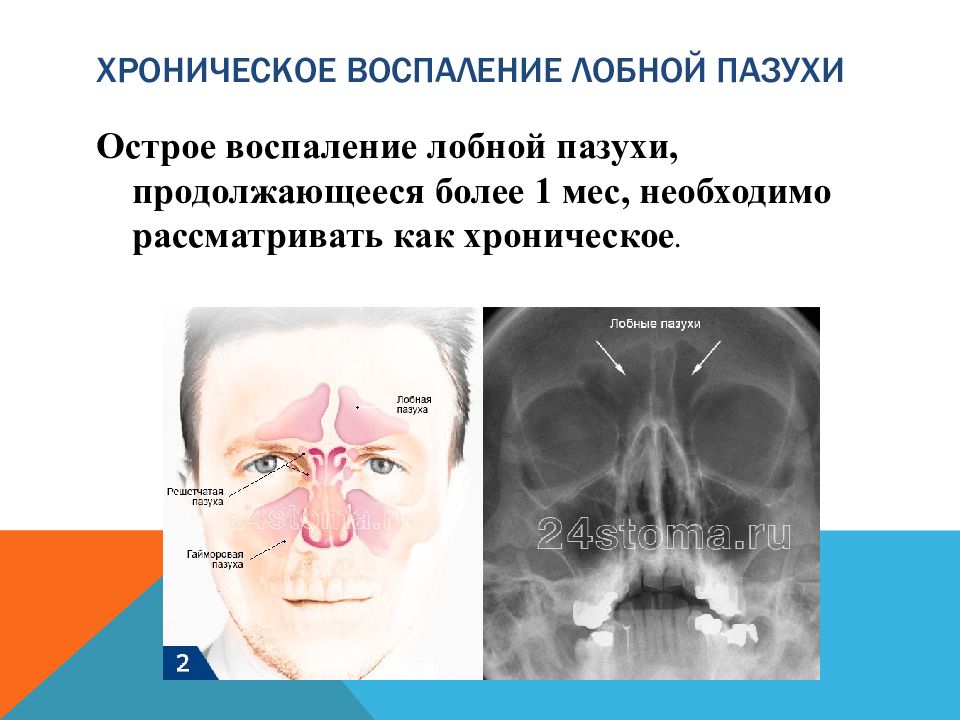 Ячейки решетчатой пазухи. Воспаление лобной пазухи. Воспаление околоносовых пазух. Воспаление решетчатой пазухи. Воспаление решетчатой кости носа.