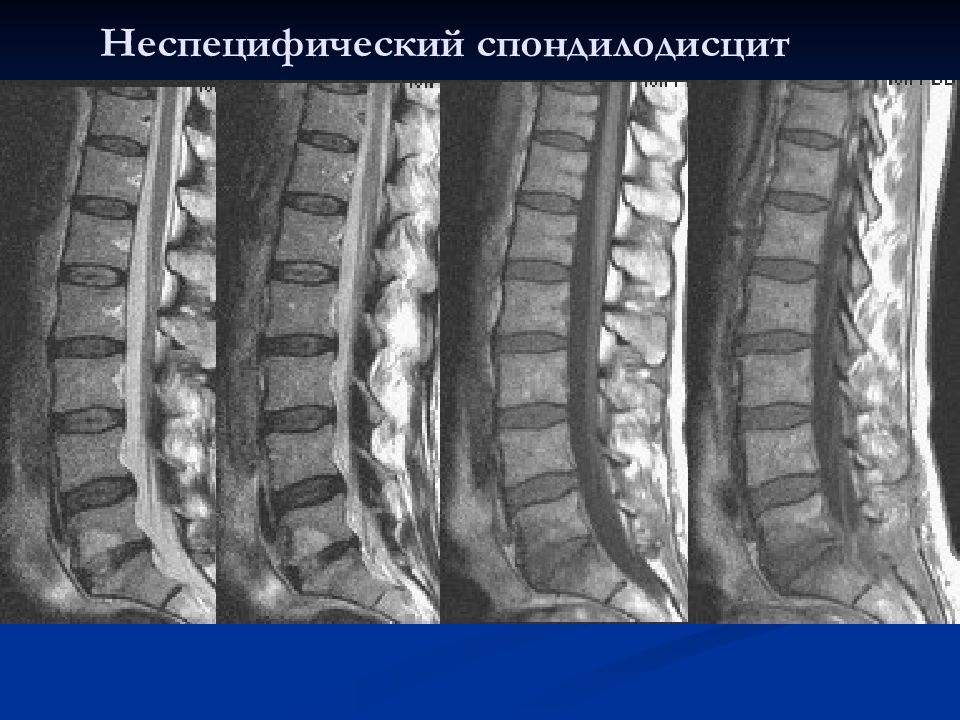 Спондилодисцит. Спондилодисцит на кт. Хронический спондилодисцит. Спондилодисцит после операции.