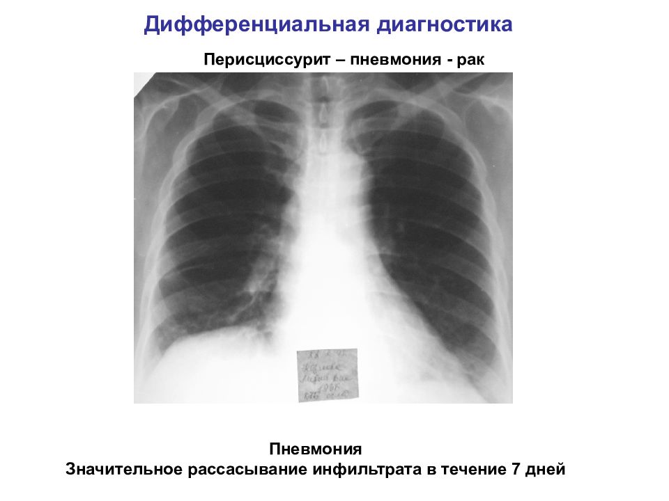 Перисциссурит рентген картина