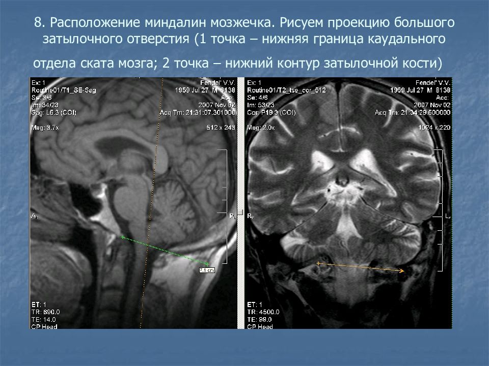 Мозжечок на уровне миндалин. Линия Чемберлена на мрт головного мозга. Опущение миндалин мозжечка мрт. Вклинение миндалин мозжечка кт. Расположение миндалин мозжечка.