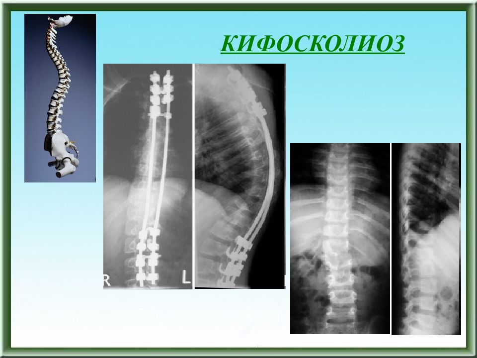 2 кифоза. Кифоз лордоз кифосколиоз. Кифосколиоз грудного отдела 1 степени. Кифосколиоз грудного отдела позвоночника степени. Кифосколиоз степени рентген.