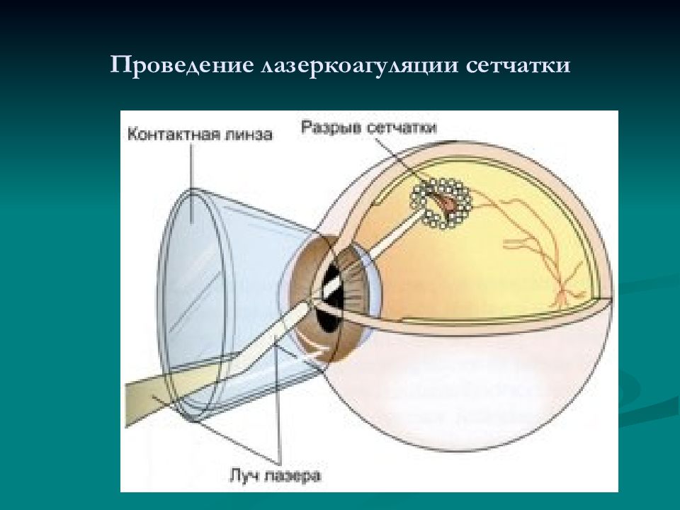 Лазерная Коагуляция Сетчатки Цена К31