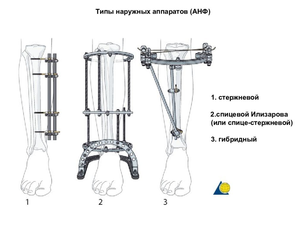 Аппарат илизарова картинки