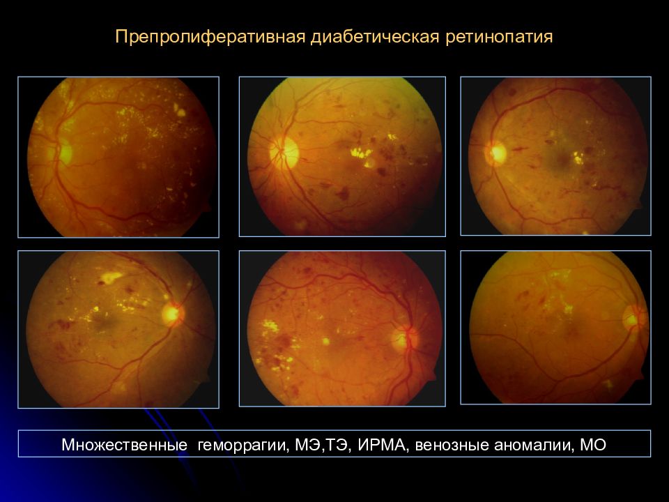 Диабетическая ретинопатия. Ретинопатия препролиферативная стадия. 3 Стадия диабетической ретинопатии. Диабетическая ретинопатия препролиферативная стадия. Ирма диабетическая ретинопатия.