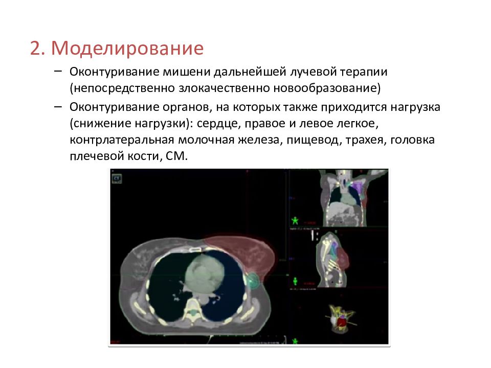 Лучевая терапия рака молочной железы презентация