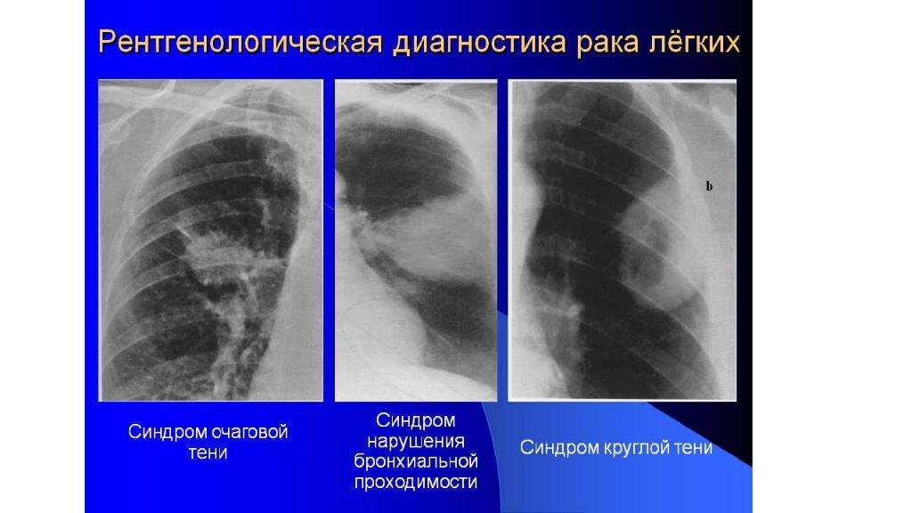 Лучевая картина центрального рака легкого